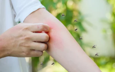 Don’t Ignore Those Mosquito Bites! How to Spot, Treat, and Prevent Them