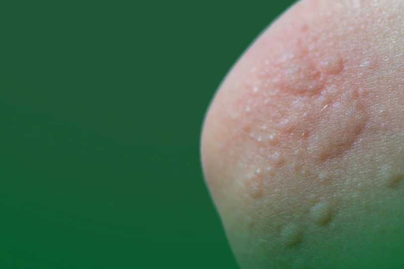 Why Cockroach Bites Shouldn't Be Ignored red spots of allergic reactions